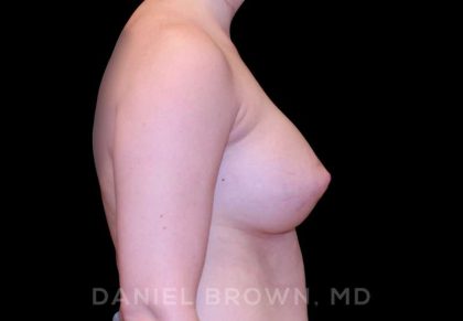 Breast Augmentation Before & After Patient #8993