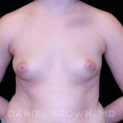 Breast Augmentation Before & After Patient #8993