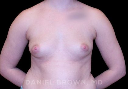 Breast Augmentation Before & After Patient #8993