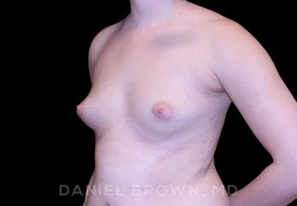 Breast Augmentation Before & After Patient #8993