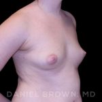 Breast Augmentation Before & After Patient #8993