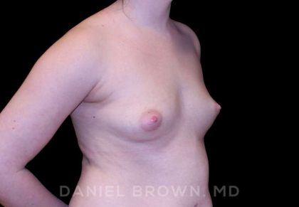 Breast Augmentation Before & After Patient #8993