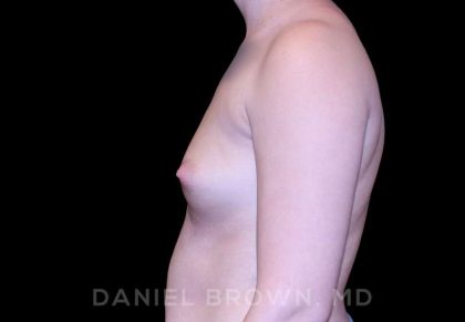 Breast Augmentation Before & After Patient #8993