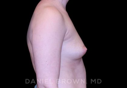 Breast Augmentation Before & After Patient #8993