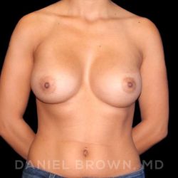Breast Augmentation Before & After Patient #9000