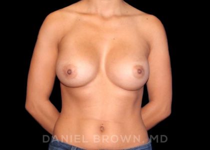 Breast Augmentation Before & After Patient #9000