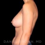 Breast Augmentation Before & After Patient #9000