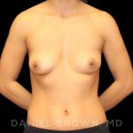 Breast Augmentation Before & After Patient #9000