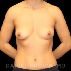 Breast Augmentation Before & After Patient #9000