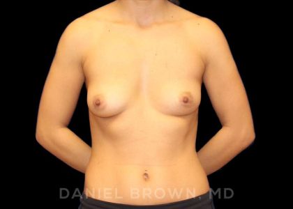 Breast Augmentation Before & After Patient #9000