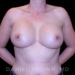 Breast Augmentation Before & After Patient #9011