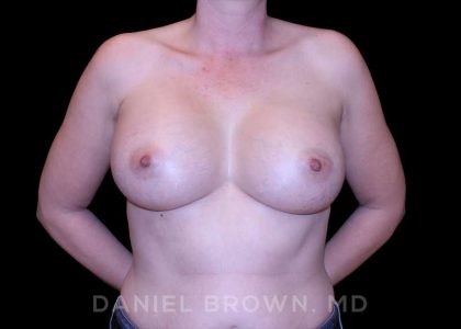 Breast Augmentation Before & After Patient #9011