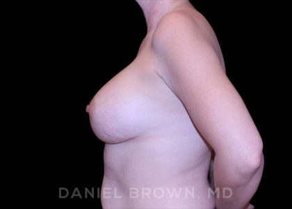 Breast Augmentation Before & After Patient #9011