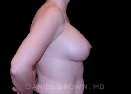 Breast Augmentation Before & After Patient #9011