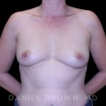 Breast Augmentation Before & After Patient #9011