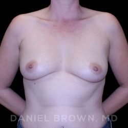 Breast Augmentation Before & After Patient #9011