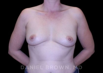 Breast Augmentation Before & After Patient #9011