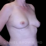 Breast Augmentation Before & After Patient #9011