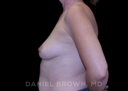 Breast Augmentation Before & After Patient #9011