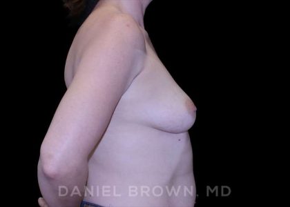 Breast Augmentation Before & After Patient #9011