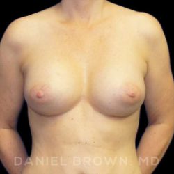Breast Augmentation Before & After Patient #9018