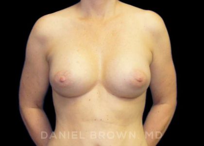 Breast Augmentation Before & After Patient #9018