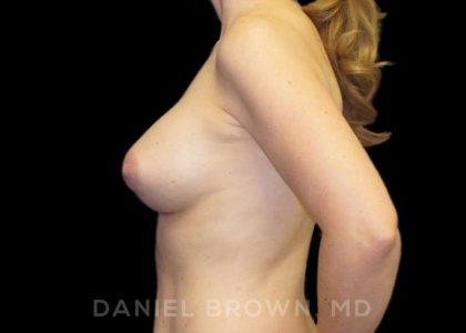 Breast Augmentation Before & After Patient #9018