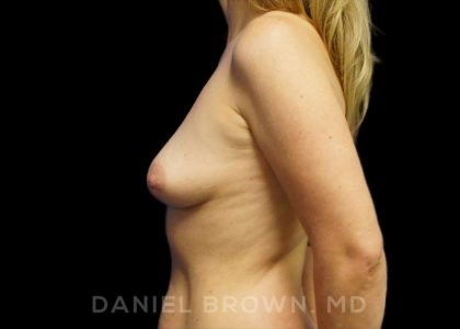 Breast Augmentation Before & After Patient #9018