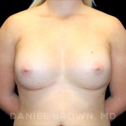 Breast Augmentation Before & After Patient #9025
