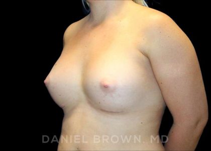 Breast Augmentation Before & After Patient #9025