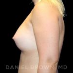 Breast Augmentation Before & After Patient #9025