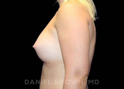 Breast Augmentation Before & After Patient #9025