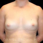 Breast Augmentation Before & After Patient #9025