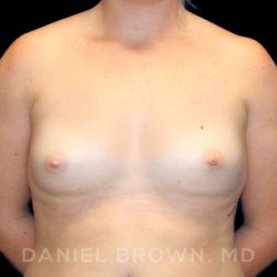 Breast Augmentation Before & After Patient #9025