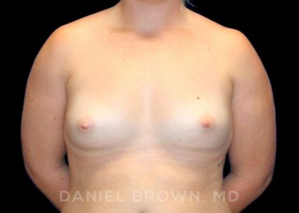 Breast Augmentation Before & After Patient #9025
