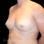 Breast Augmentation Before & After Patient #9025