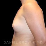 Breast Augmentation Before & After Patient #9025