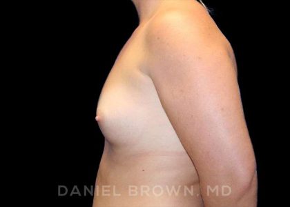Breast Augmentation Before & After Patient #9025
