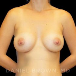 Breast Augmentation Before & After Patient #9032
