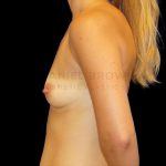 Breast Augmentation Before & After Patient #9032