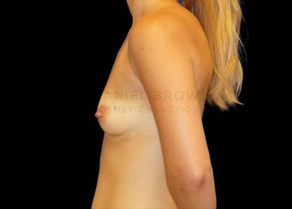 Breast Augmentation Before & After Patient #9032