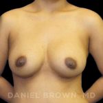 Breast Augmentation Before & After Patient #9039