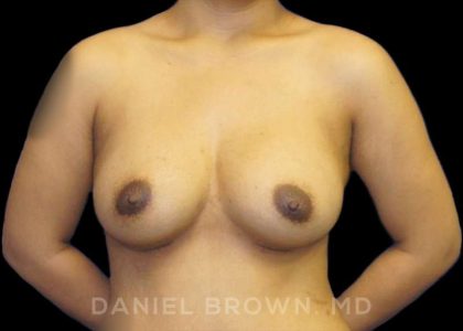 Breast Augmentation Before & After Patient #9039