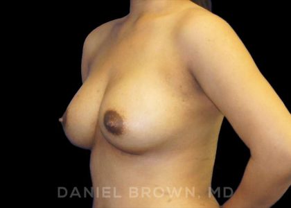 Breast Augmentation Before & After Patient #9039
