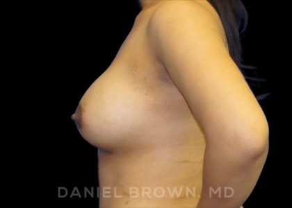 Breast Augmentation Before & After Patient #9039