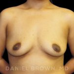 Breast Augmentation Before & After Patient #9039