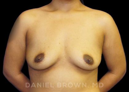 Breast Augmentation Before & After Patient #9039