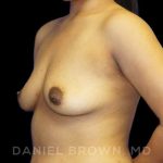 Breast Augmentation Before & After Patient #9039