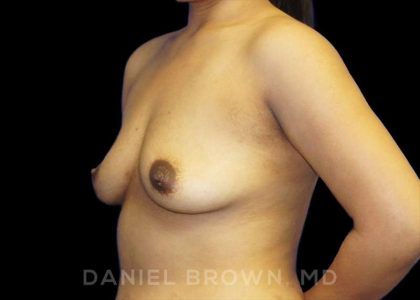 Breast Augmentation Before & After Patient #9039