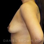Breast Augmentation Before & After Patient #9039